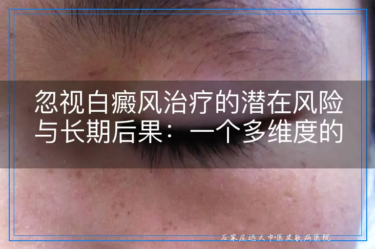 忽视白癜风治疗的潜在风险与长期后果：一个多维度的审视