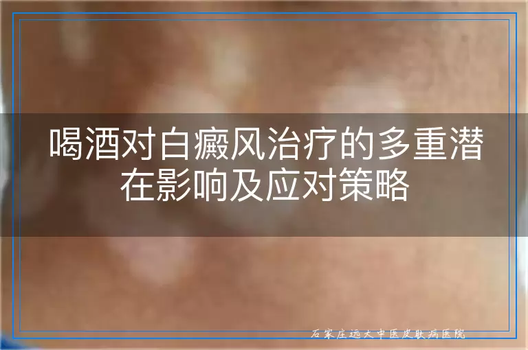 喝酒对白癜风治疗的多重潜在影响及应对策略