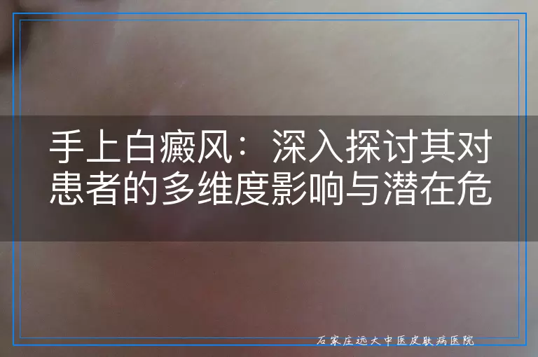 手上白癜风：深入探讨其对患者的多维度影响与潜在危害