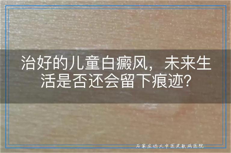 治好的儿童白癜风，未来生活是否还会留下痕迹？