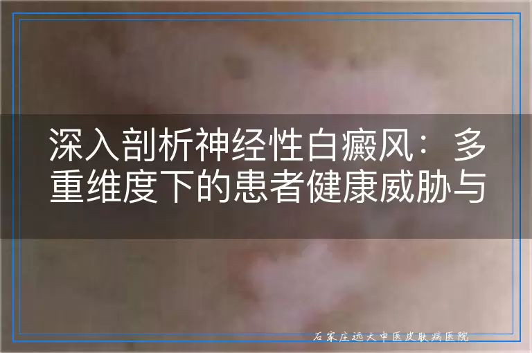 深入剖析神经性白癜风：多重维度下的患者健康威胁与挑战