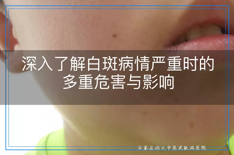深入了解白斑病情严重时的多重危害与影响