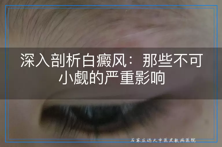 深入剖析白癜风：那些不可小觑的严重影响
