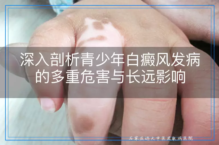 深入剖析青少年白癜风发病的多重危害与长远影响