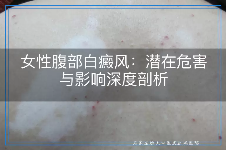 女性腹部白癜风：潜在危害与影响深度剖析