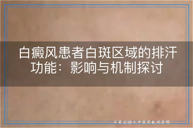 白癜风患者白斑区域的排汗功能：影响与机制探讨