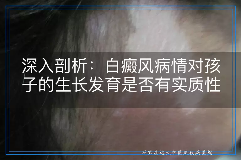 深入剖析：白癜风病情对孩子的生长发育是否有实质性影响？