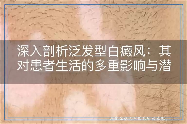 深入剖析泛发型白癜风：其对患者生活的多重影响与潜在危害