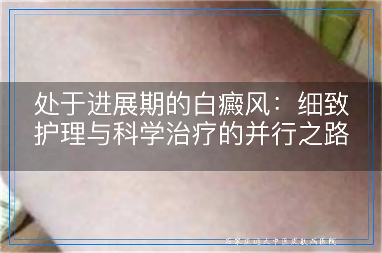 处于进展期的白癜风：细致护理与科学治疗的并行之路
