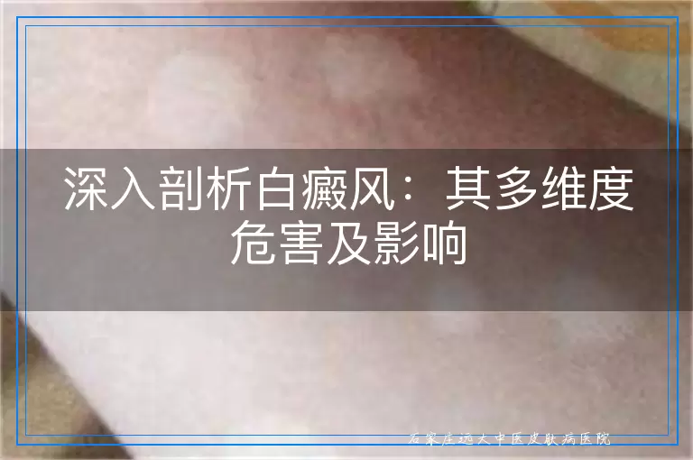 深入剖析白癜风：其多维度危害及影响
