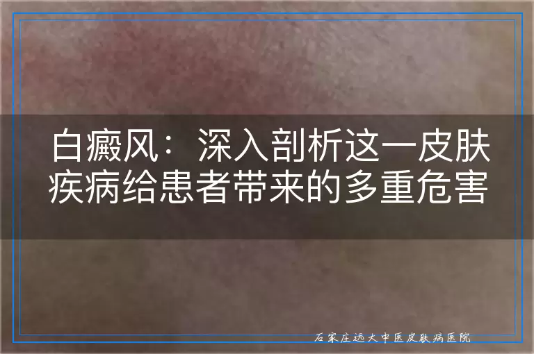 白癜风：深入剖析这一皮肤疾病给患者带来的多重危害与挑战