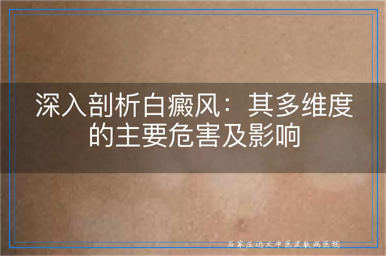 深入剖析白癜风：其多维度的主要危害及影响