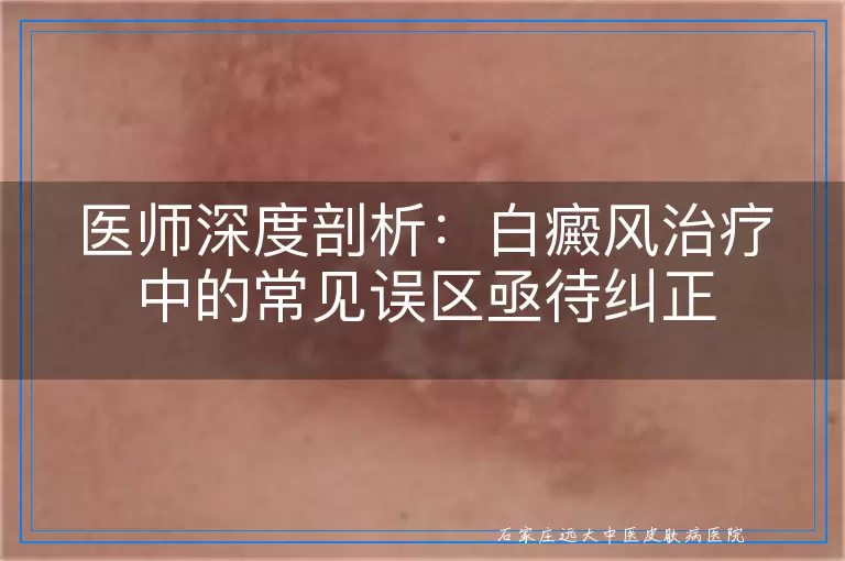 医师深度剖析：白癜风治疗中的常见误区亟待纠正