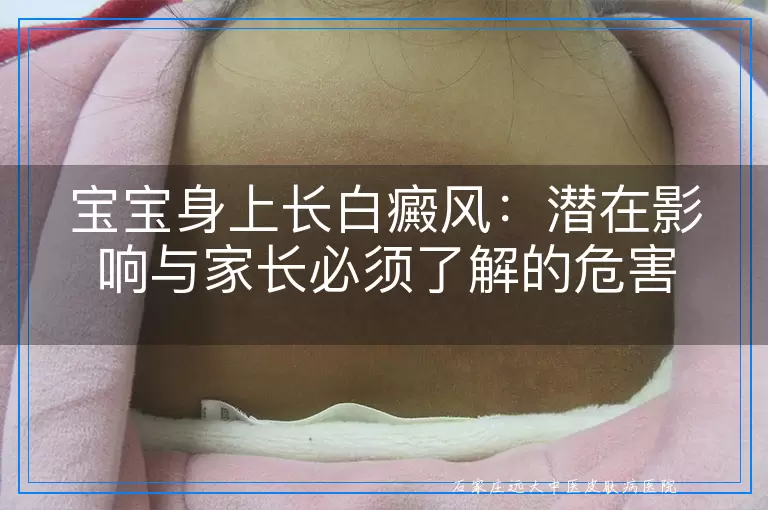 宝宝身上长白癜风：潜在影响与家长必须了解的危害