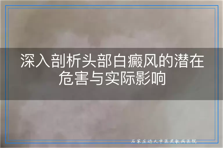 深入剖析头部白癜风的潜在危害与实际影响