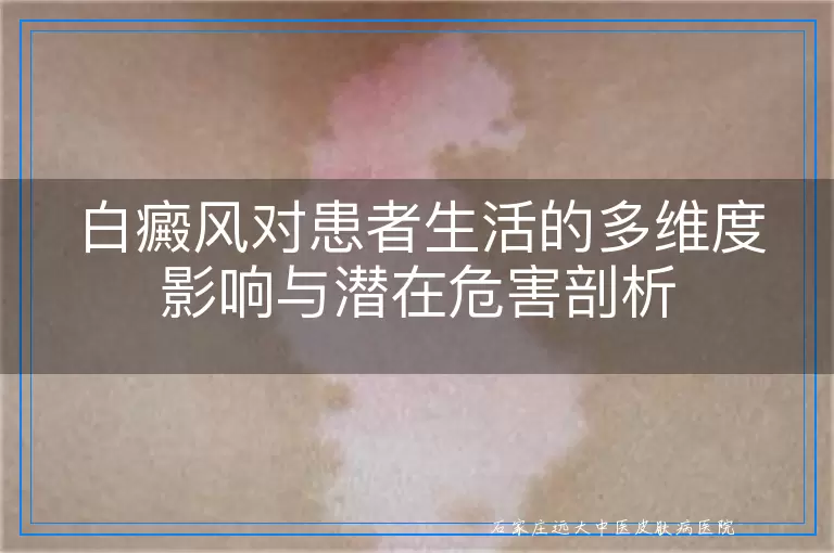 白癜风对患者生活的多维度影响与潜在危害剖析