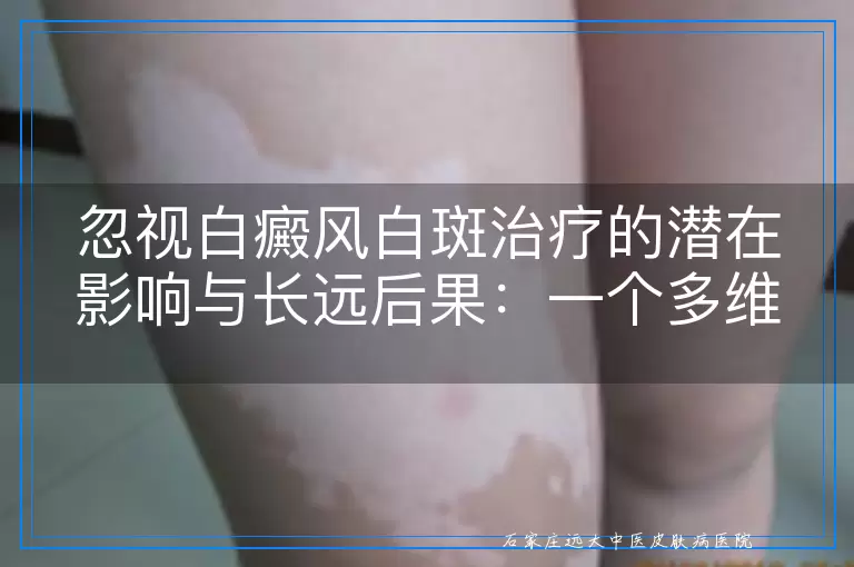 忽视白癜风白斑治疗的潜在影响与长远后果：一个多维度的审视