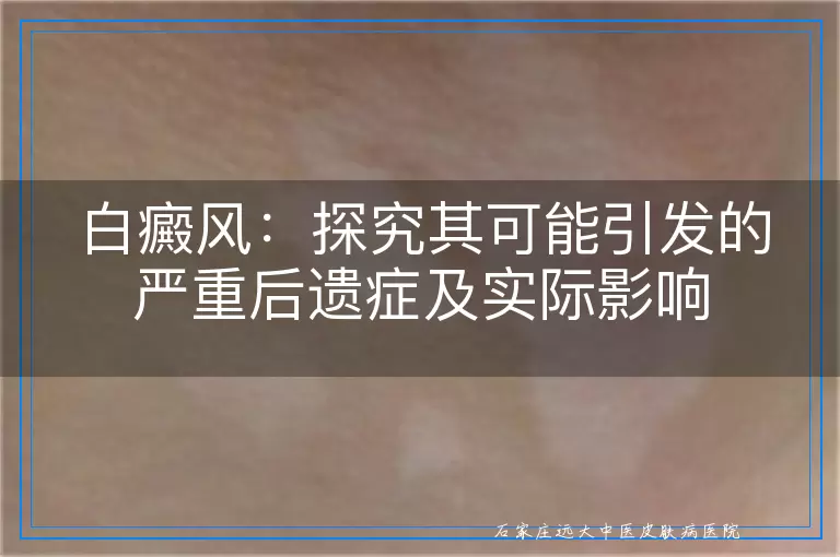 白癜风：探究其可能引发的严重后遗症及实际影响