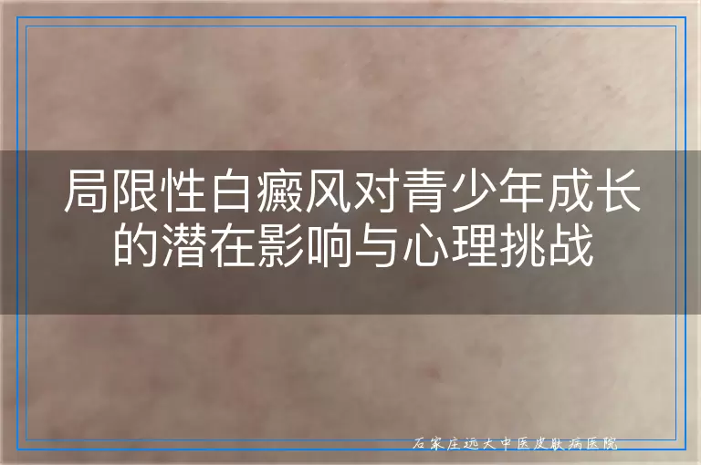 局限性白癜风对青少年成长的潜在影响与心理挑战