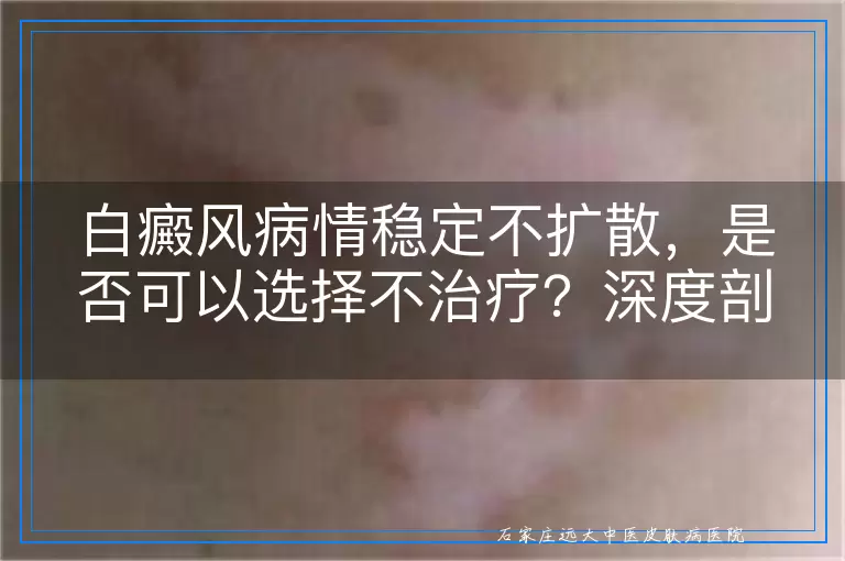 白癜风病情稳定不扩散，是否可以选择不治疗？深度剖析与考量