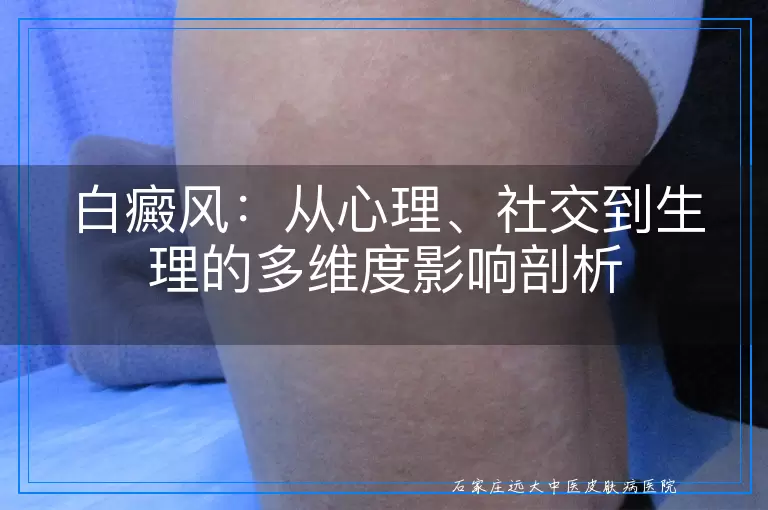 白癜风：从心理、社交到生理的多维度影响剖析