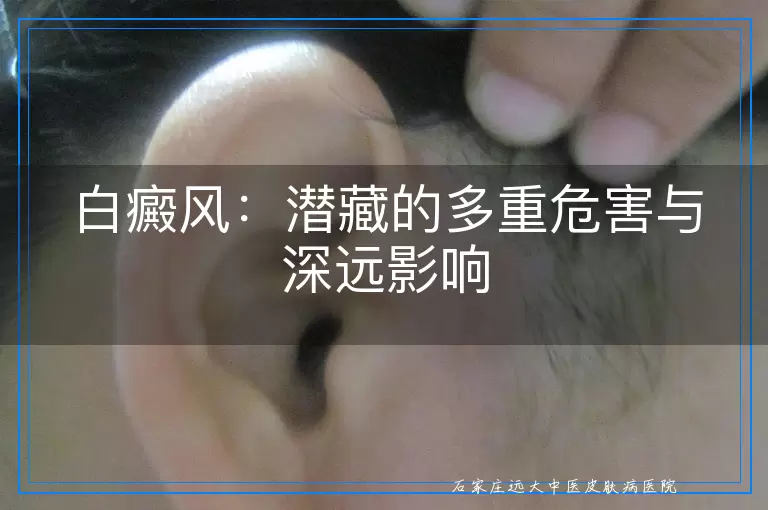 白癜风：潜藏的多重危害与深远影响