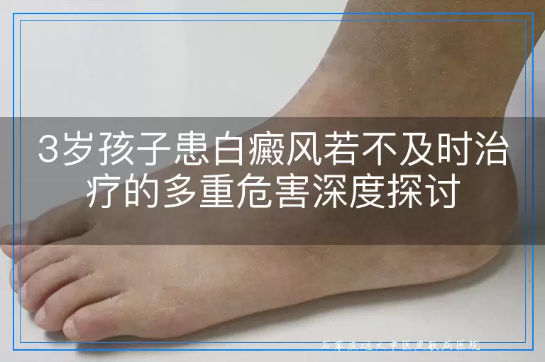 3岁孩子患白癜风若不及时治疗的多重危害深度探讨