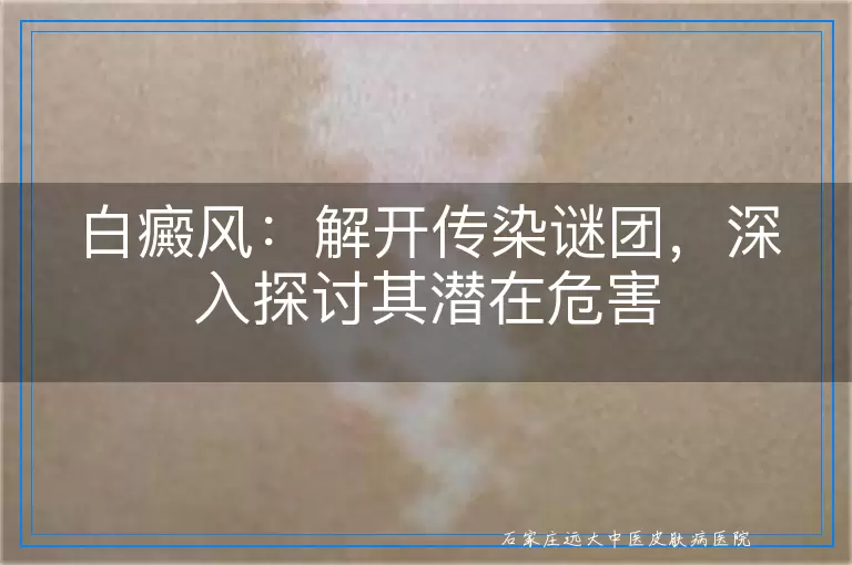 白癜风：解开传染谜团，深入探讨其潜在危害