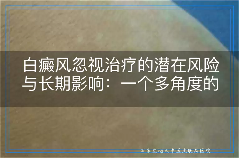 白癜风忽视治疗的潜在风险与长期影响：一个多角度的审视