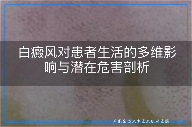 白癜风对患者生活的多维影响与潜在危害剖析
