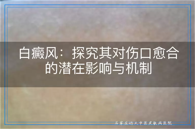 白癜风：探究其对伤口愈合的潜在影响与机制