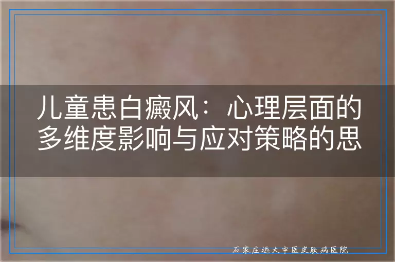 儿童患白癜风：心理层面的多维度影响与应对策略的思考