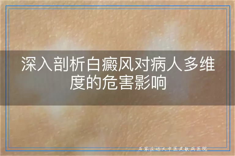 深入剖析白癜风对病人多维度的危害影响