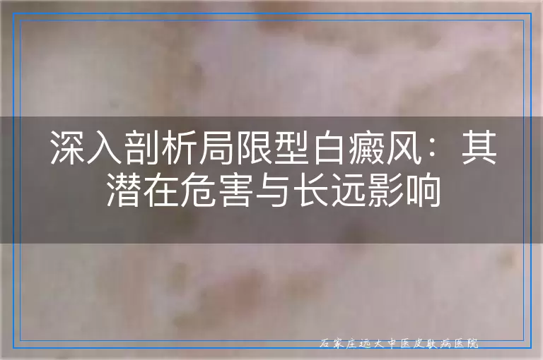 深入剖析局限型白癜风：其潜在危害与长远影响