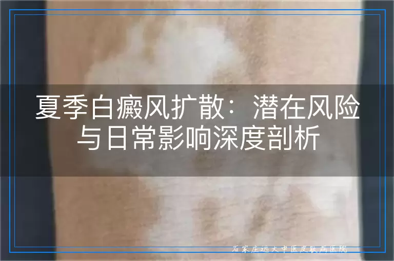 夏季白癜风扩散：潜在风险与日常影响深度剖析