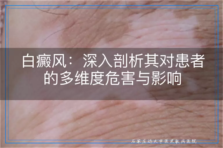 白癜风：深入剖析其对患者的多维度危害与影响
