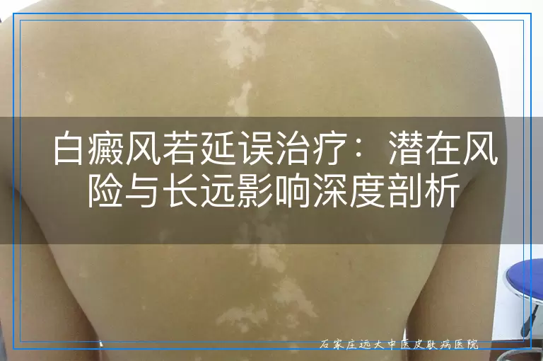 白癜风若延误治疗：潜在风险与长远影响深度剖析