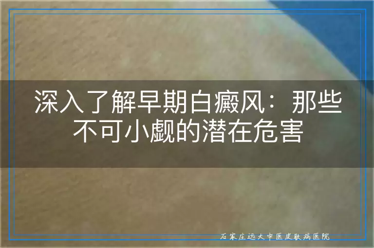 深入了解早期白癜风：那些不可小觑的潜在危害