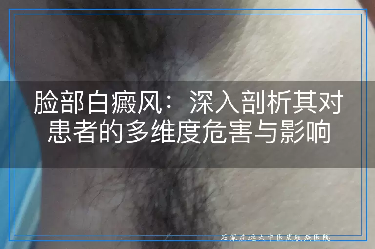 脸部白癜风：深入剖析其对患者的多维度危害与影响