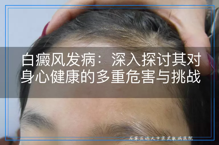 白癜风发病：深入探讨其对身心健康的多重危害与挑战