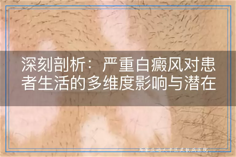 深刻剖析：严重白癜风对患者生活的多维度影响与潜在危害
