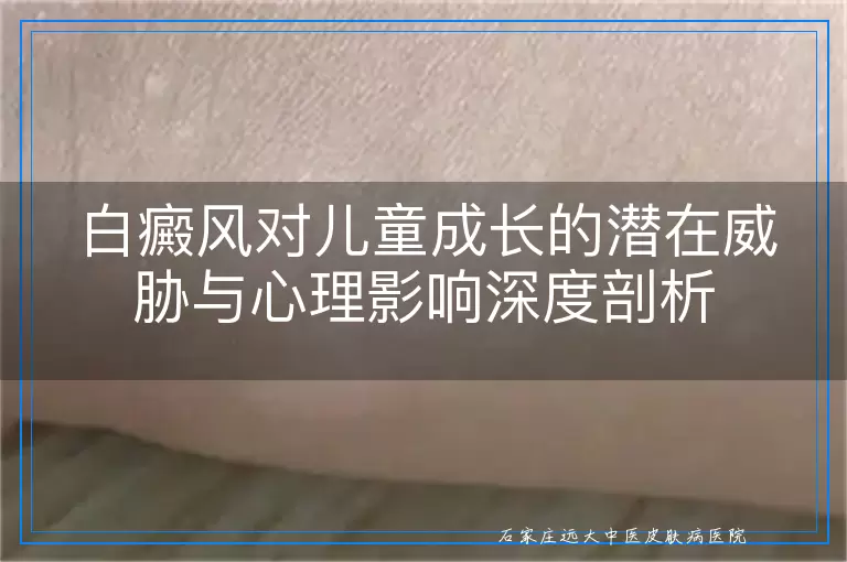 白癜风对儿童成长的潜在威胁与心理影响深度剖析