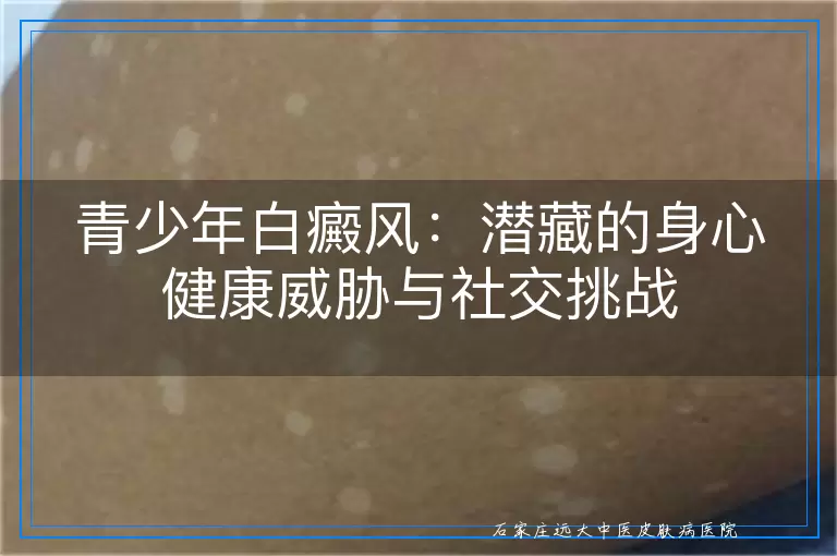 青少年白癜风：潜藏的身心健康威胁与社交挑战