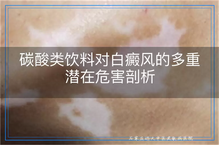 碳酸类饮料对白癜风的多重潜在危害剖析