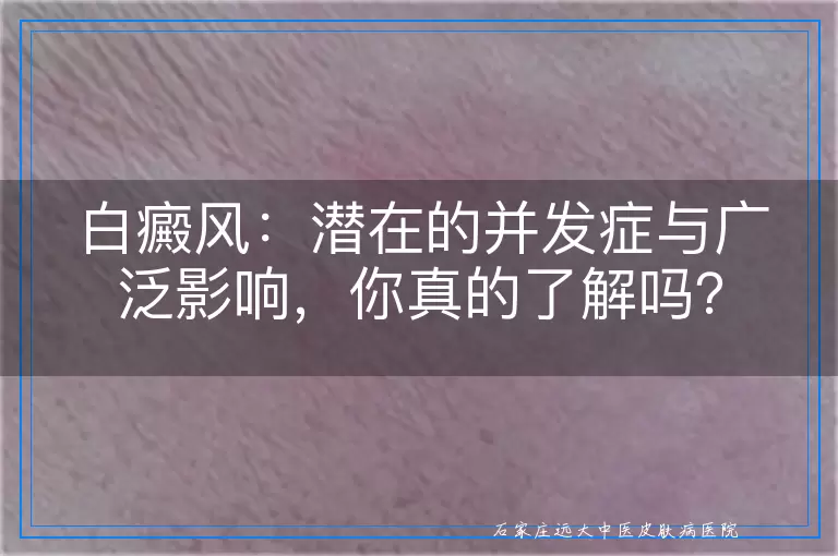 白癜风：潜在的并发症与广泛影响，你真的了解吗？