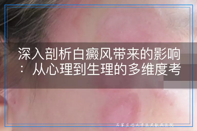 深入剖析白癜风带来的影响：从心理到生理的多维度考量