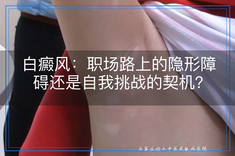 白癜风：职场路上的隐形障碍还是自我挑战的契机？