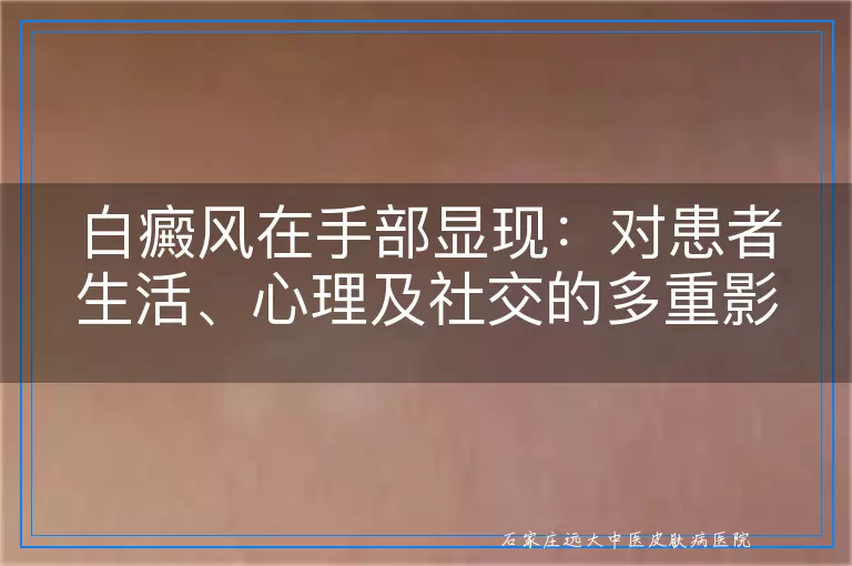 白癜风在手部显现：对患者生活、心理及社交的多重影响