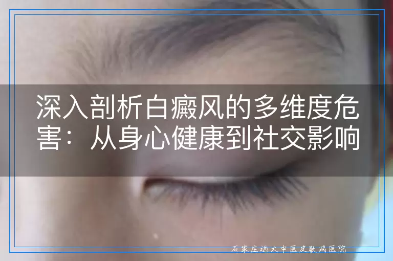 深入剖析白癜风的多维度危害：从身心健康到社交影响的全面审视