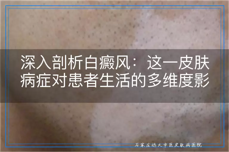 深入剖析白癜风：这一皮肤病症对患者生活的多维度影响与潜在危害